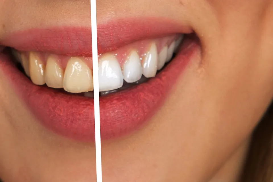 Whitening Before-After