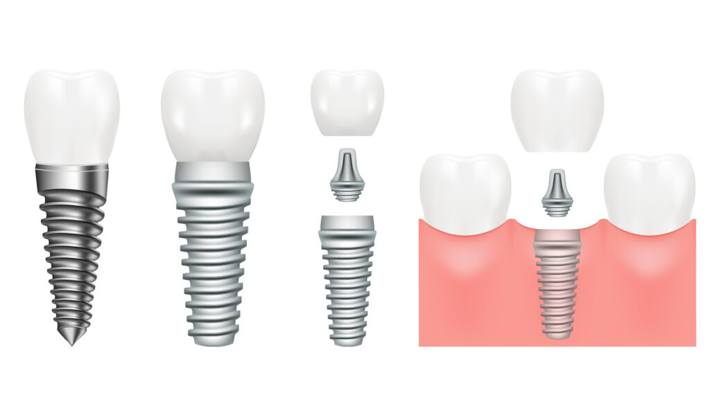 Realistic dental implant structure with all parts crown, abutment, screw. Dentistry. Implantation of human teeth. Vector illustration, eps 10